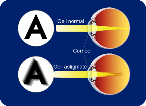 Opération de l'astigmatisme