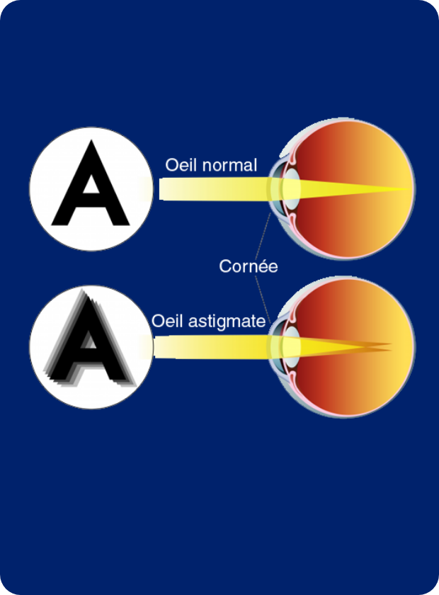 Opération de l'astigmatisme