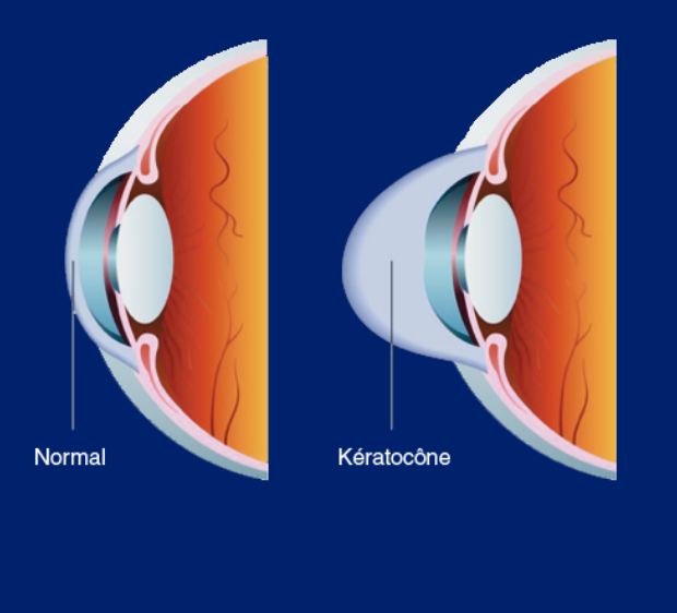 Opération du kératocône
