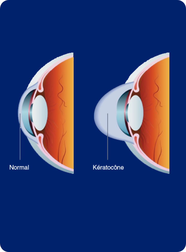 Opération du kératocône