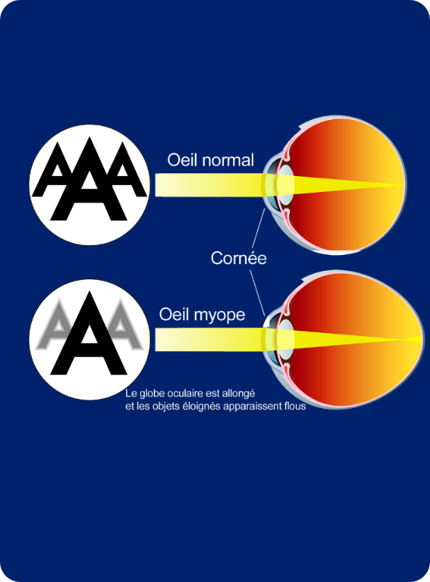 Opération de la myopie