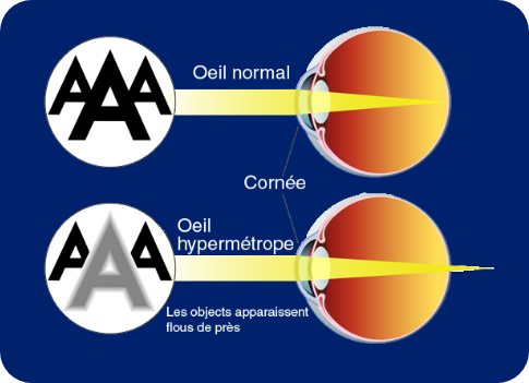 hypermetropie 2