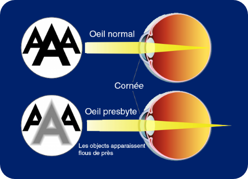 Opération de la presbytie