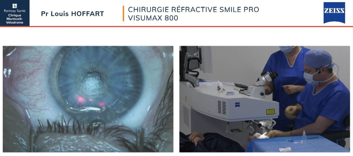 opération myopie par chirurgie réfractive smile pro