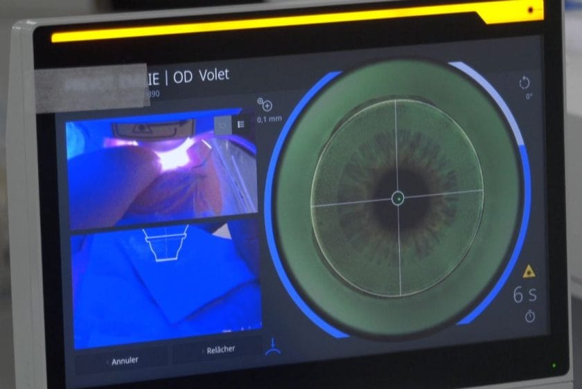 opération smile pro avec femtoseconde zeiss